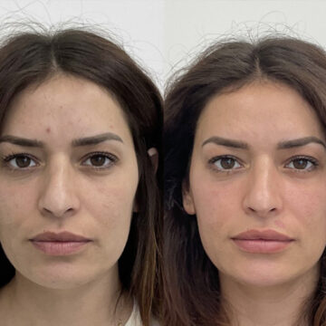 botox before and after #1