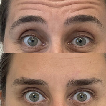 botox before and after #2