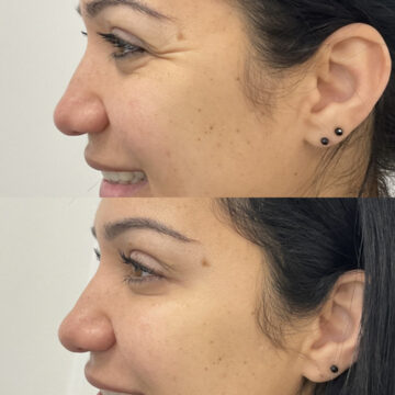 botox before and after #3