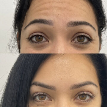 botox before and after #4