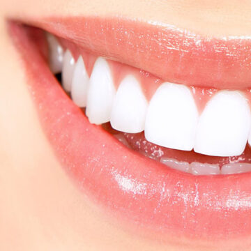 web-006 Botox gummy smile