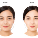 Masseter botox