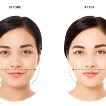 web-007 Masseter botox